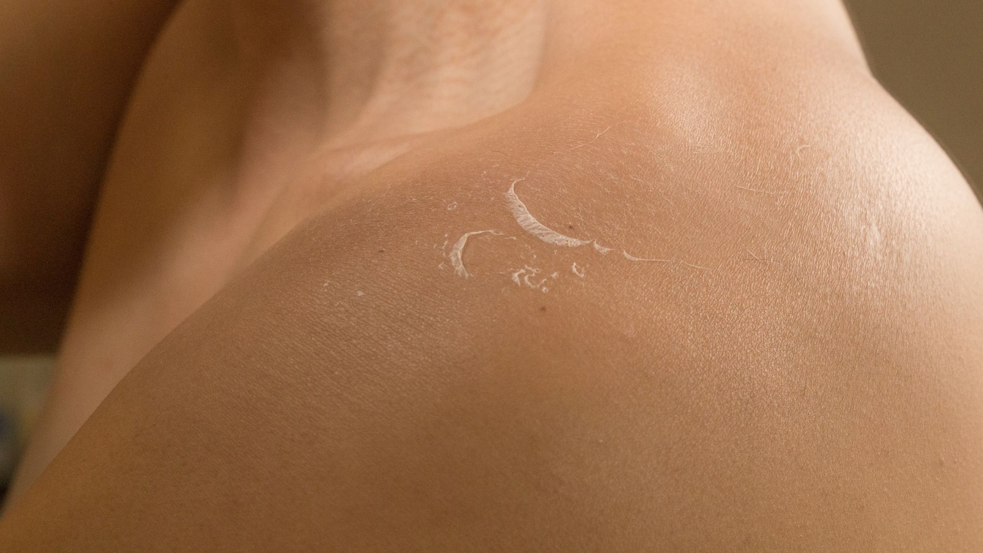 Kako spriječiti guljenje kože nakon ljetovanja (1920 × 1080 piks.).jpg